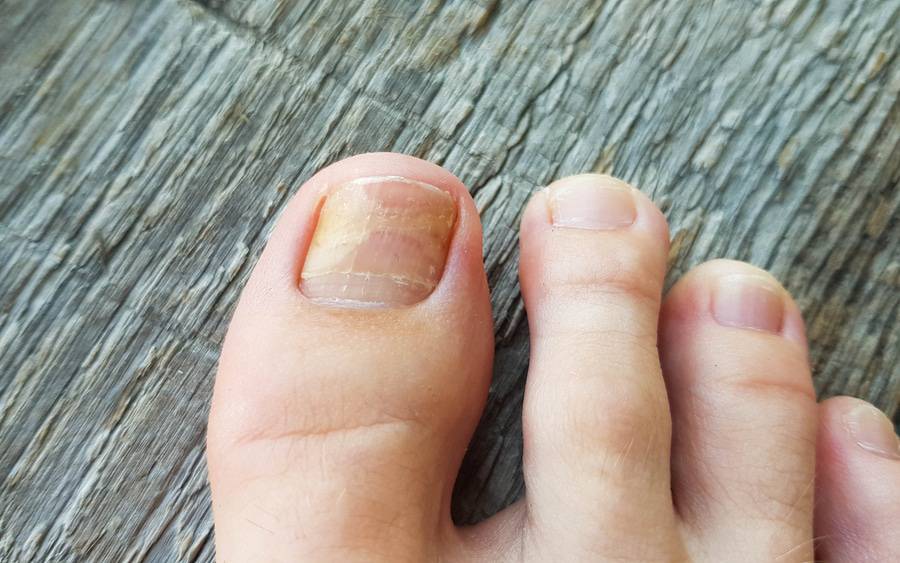 Fungal Nail Infections | Ausmed