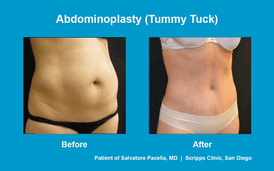 How Drainless Tummy Tucks Improve Recovery & Results, San Diego