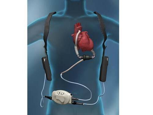 LVAD Information Session