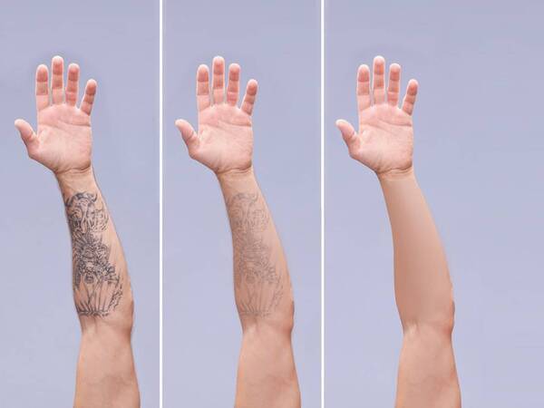 Laser Tattoo Removal in Manchester | Everything Skin Clinic