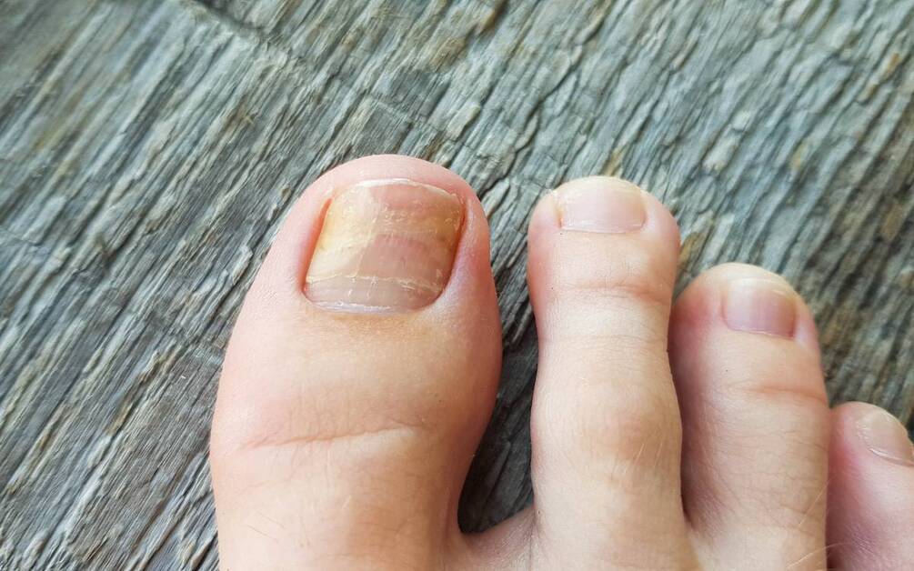 Fingernail infection (paronychia)